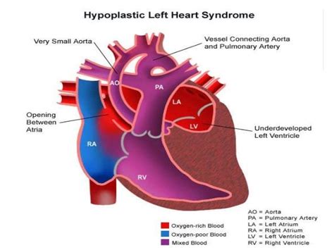 ventricular outflow tract obstruction symptoms